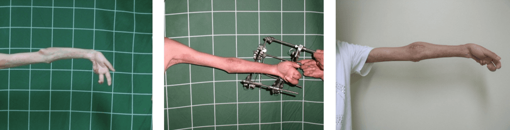 Correction of Wrist Joint Contracture