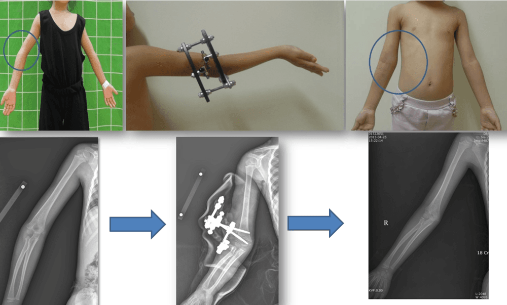 Upper Limb Deformity Correction 2