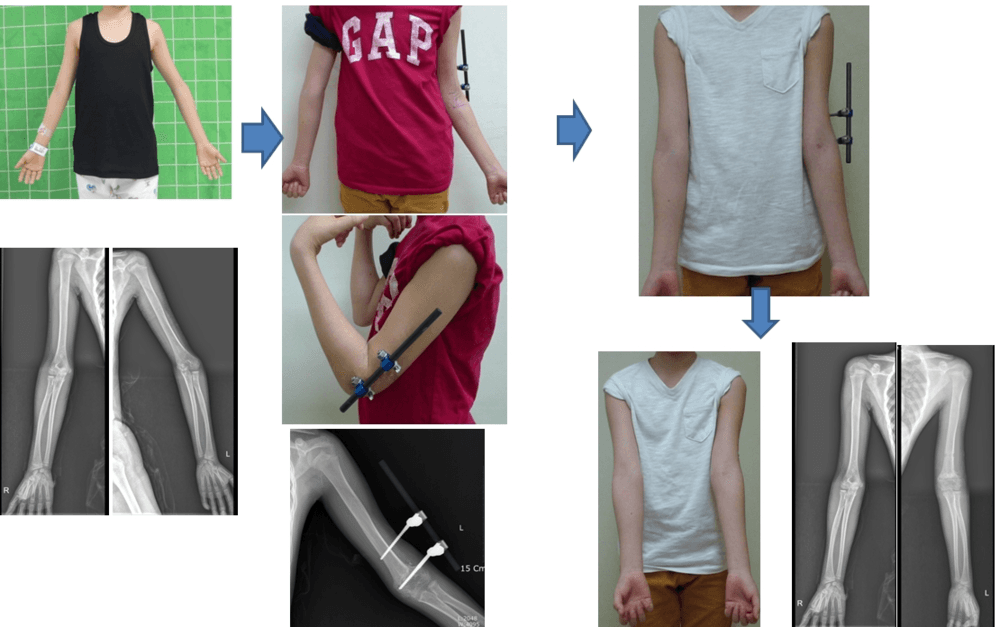 Upper Limb Deformity Correction 1