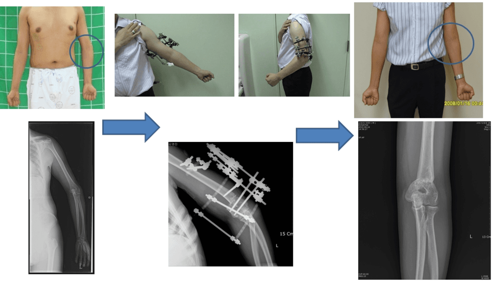 Upper Limb Deformity Correction 3
