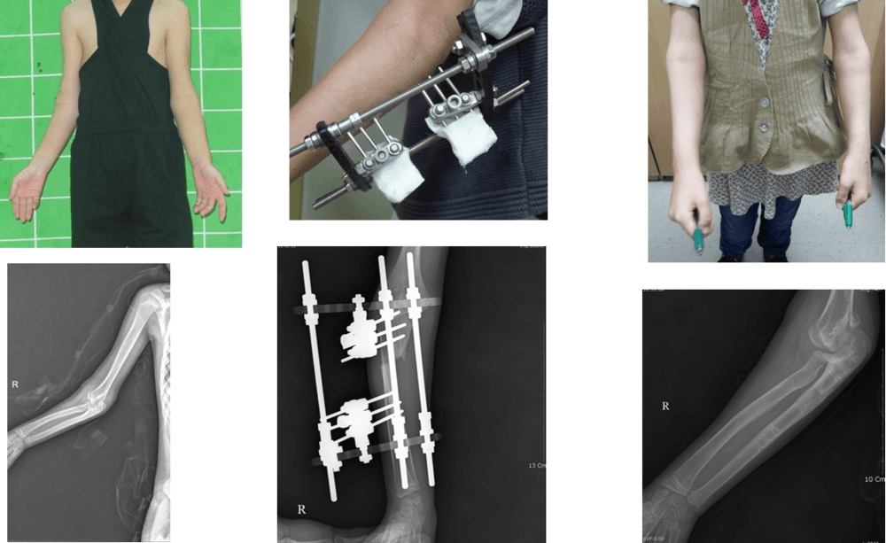 伴有生长板损伤骨折后畸形的矫正
