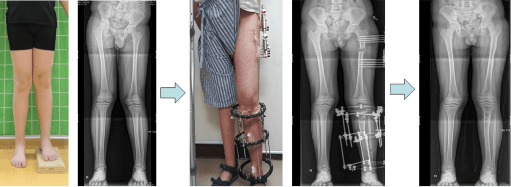 Femoral and Tibial Lengthening in Patient with Leg Length Discrepancy