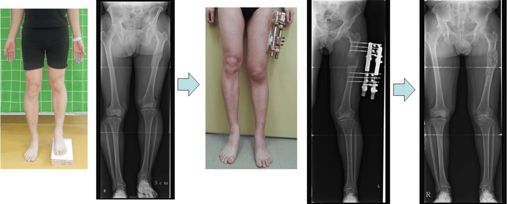 Femoral Lengthening in Patient with Leg Length Discrepancy
