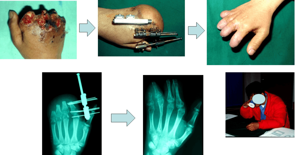 外伤性截指后的手指延长