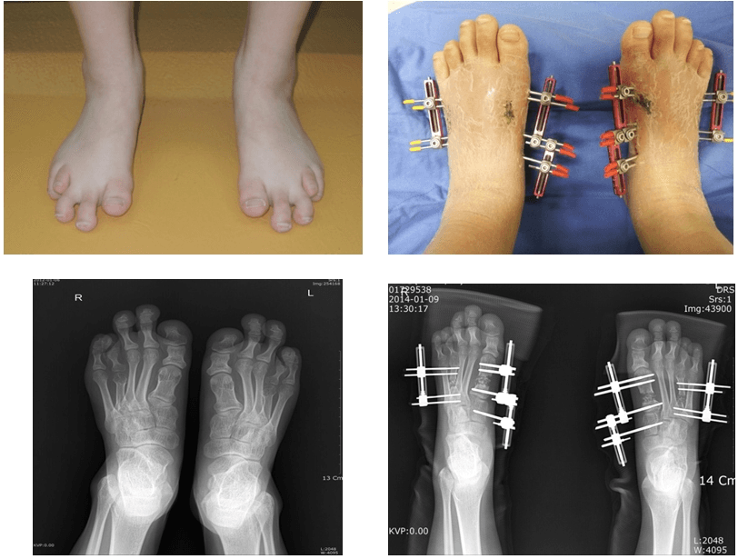 Toe Lengthening in Patient with Brachymetatarsia