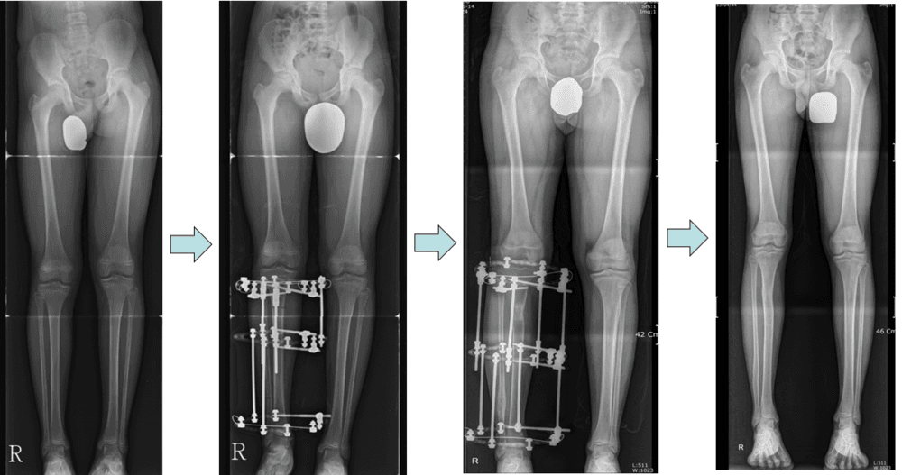 Tibial Lengthening in Patient with Leg Length Discrepancy
