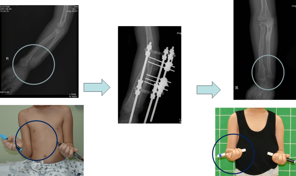多发性骨软骨瘤患者的上肢畸形矫正与延长