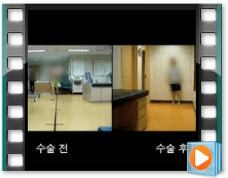 （术前/术后）步态 1