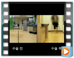 （术前/术后）步态 2