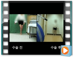 （术前/术后）步态 3