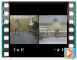 （术前/术后）步态 4