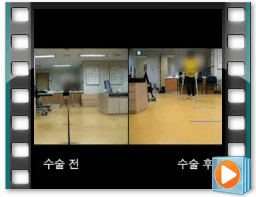 （术前/术后）步态 5