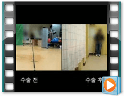 （术前/术后）步态 6