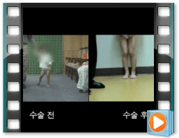 （术前/术后）步态 7