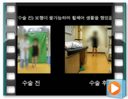 （术前/术后）步态 8