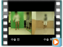 （术前/术后）步态 10