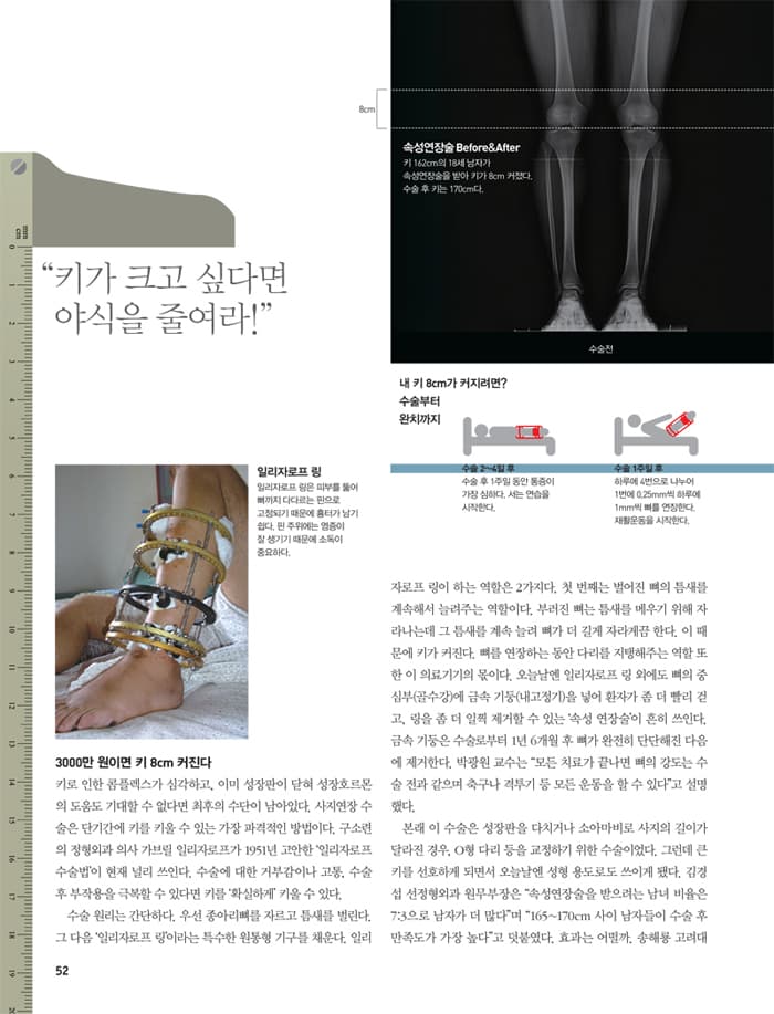 Limb lengthening surgery guide - Infographic 5