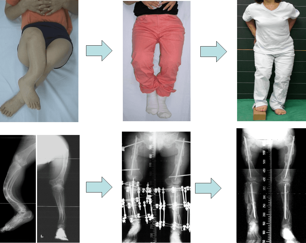 골형성부전증환자의 하지변형에 대한 교정술