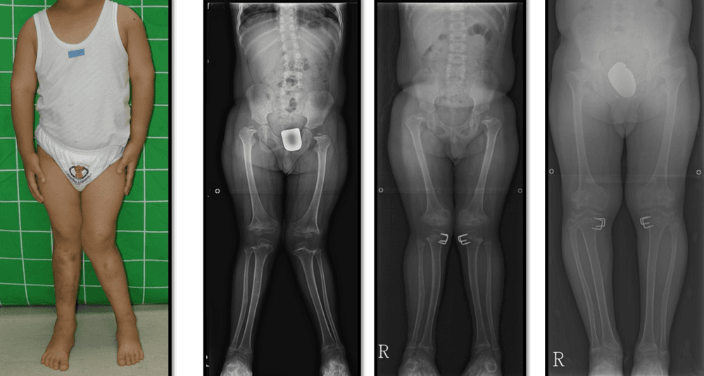 다발성골단이형성증환자의 하지변형에 대한 교정 3