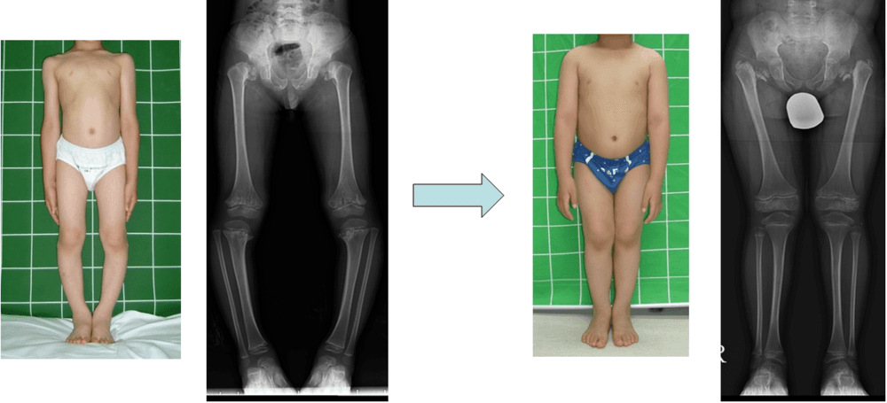 다발성골단이형성증환자의 하지변형에 대한 교정 2