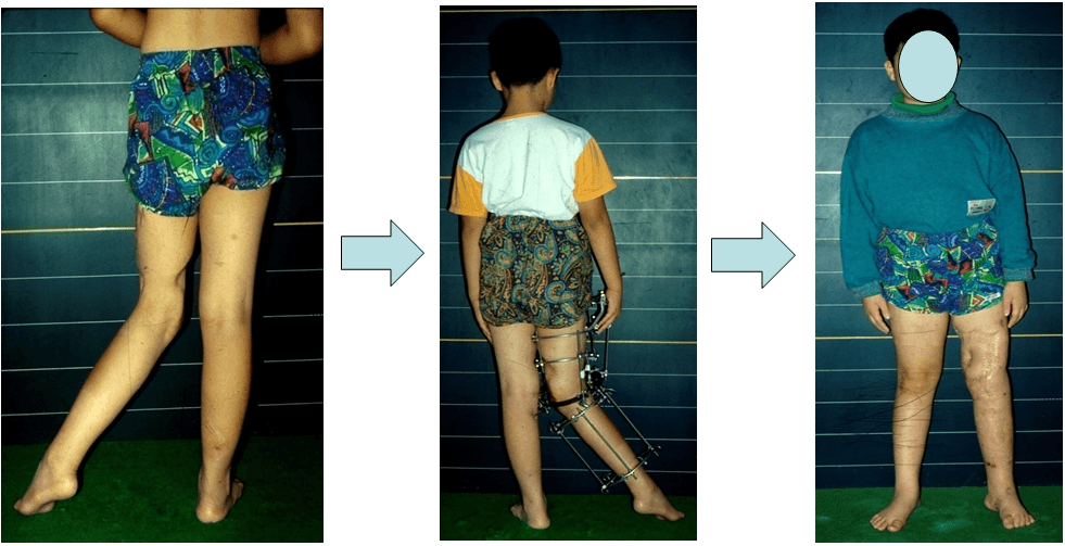하지변형에 대한교정
