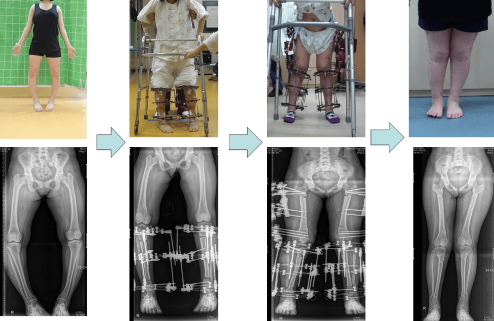 비타민디저항성구루병환자의 하지변형에 대한 교정 2