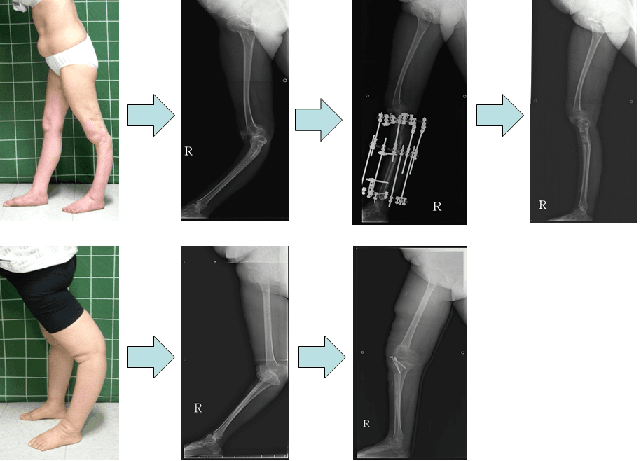 소아마비환자의 하지변형에 대한 교정
