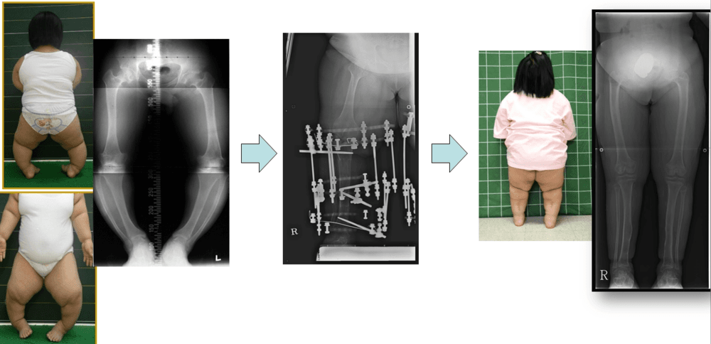 연골무형성증환자의 하지변형에 대한 교정