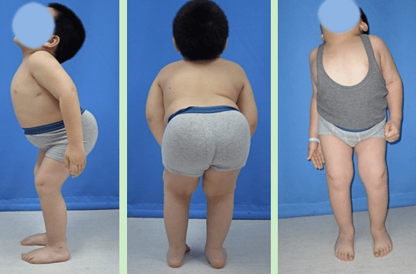 척추골단이형성증 환자의 고관절 교정