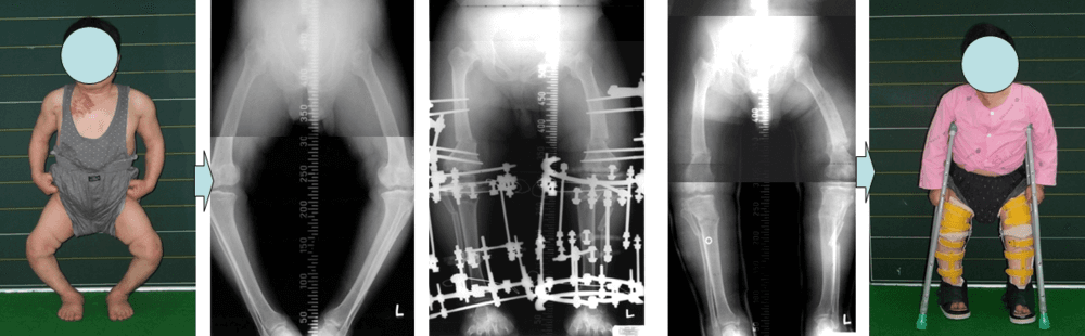 가성연골무형성증환자의 하지변형에 대한 교정