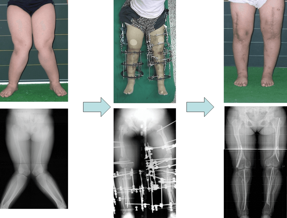 밖으로 휜 다리의 교정