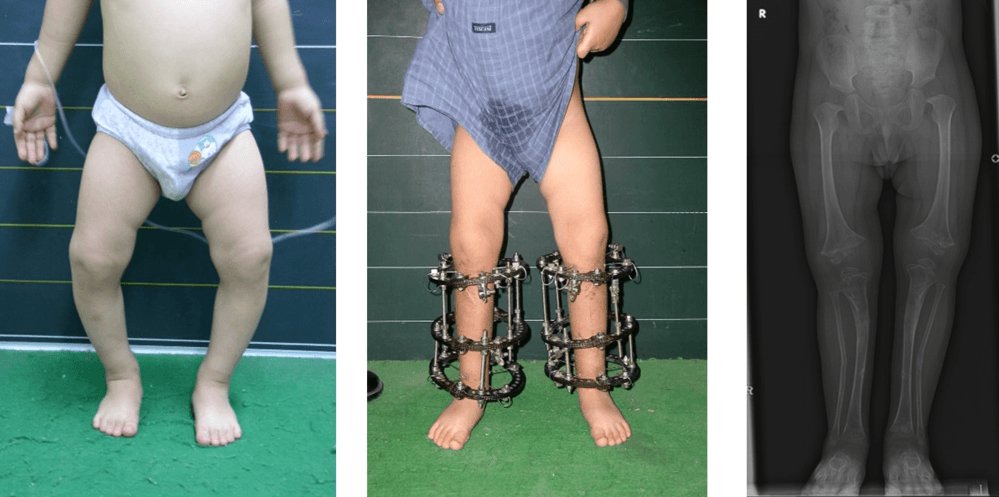 다발성골단이형성증환자의 하지변형에 대한 교정 1