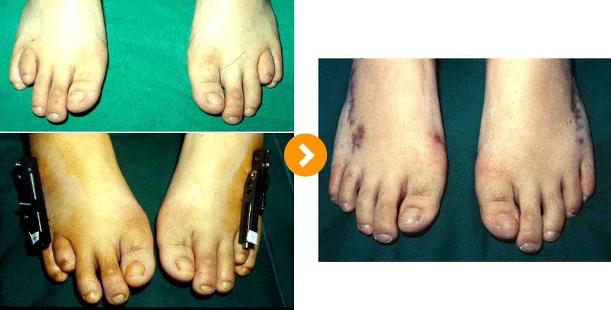 Brachydactyly Lengthening
