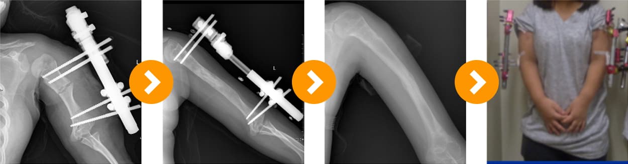 Achondroplasia: Upper Limb Lengthening 10 cm