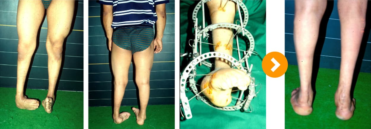Foot Deformity: Ilizarov Correction