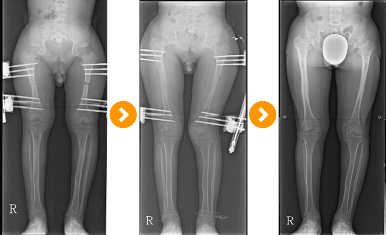 Achondroplasia: Tibial Lengthening (8 cm) and Femoral Lengthening (8 cm)