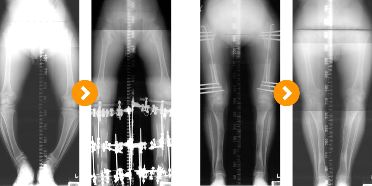 Achondroplasia: Bow Leg Correction and Bone Lengthening 10 cm