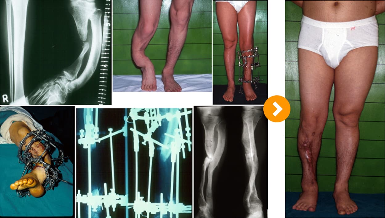 Tibial Osteomyelitis: Deformity Correction and Bone Lengthening